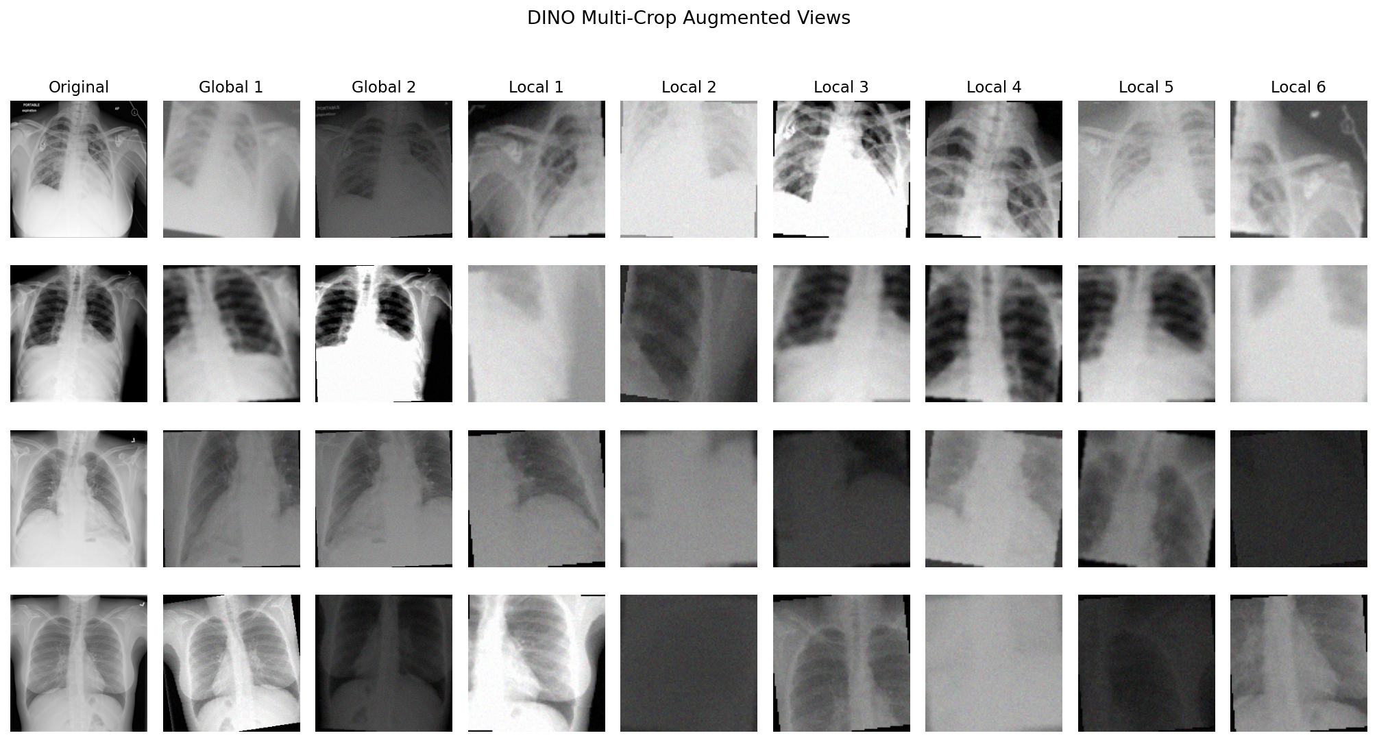 DINO multi-crop augmented views: original X-ray beside two global crops the teacher and student each see