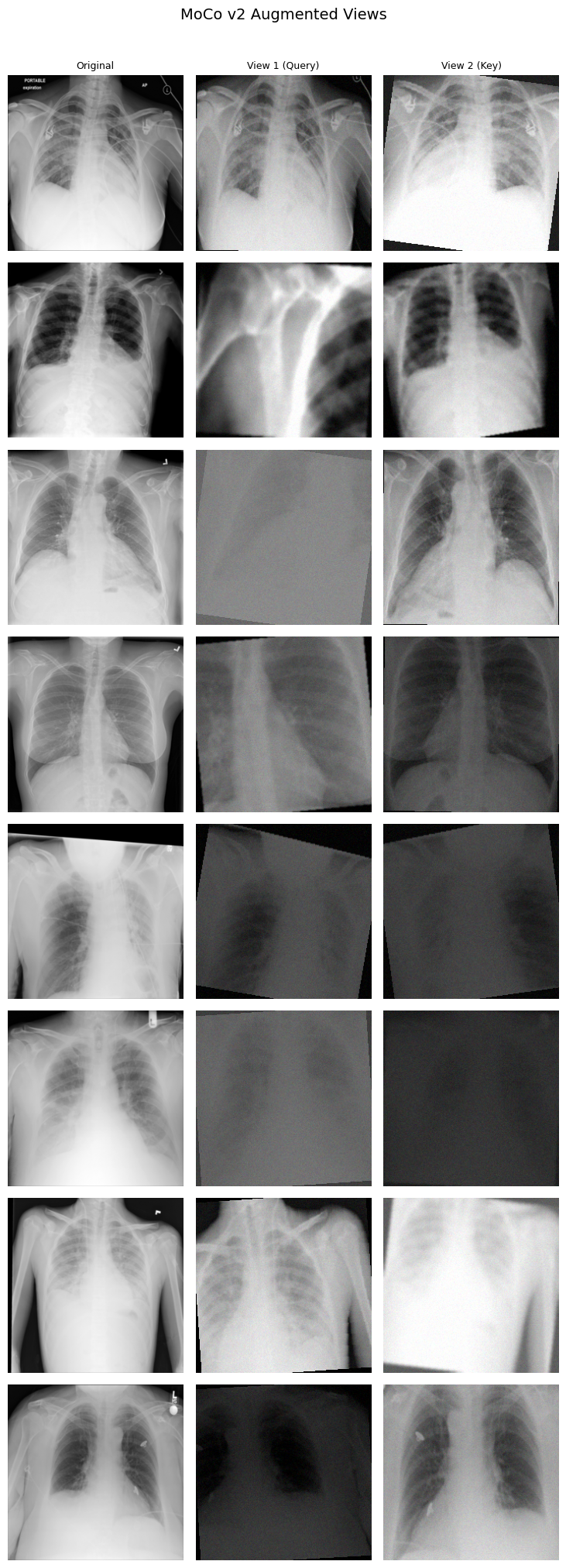 MoCo v2 augmented views: original X-ray beside two randomly cropped and augmented versions
