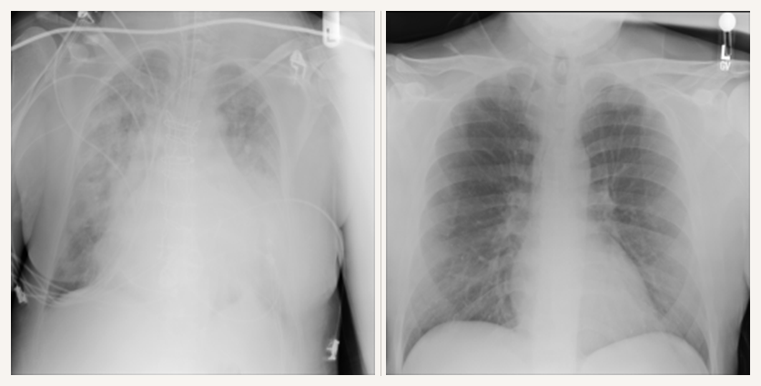 COVID-positive patient supine in ICU bed next to COVID-negative control standing upright