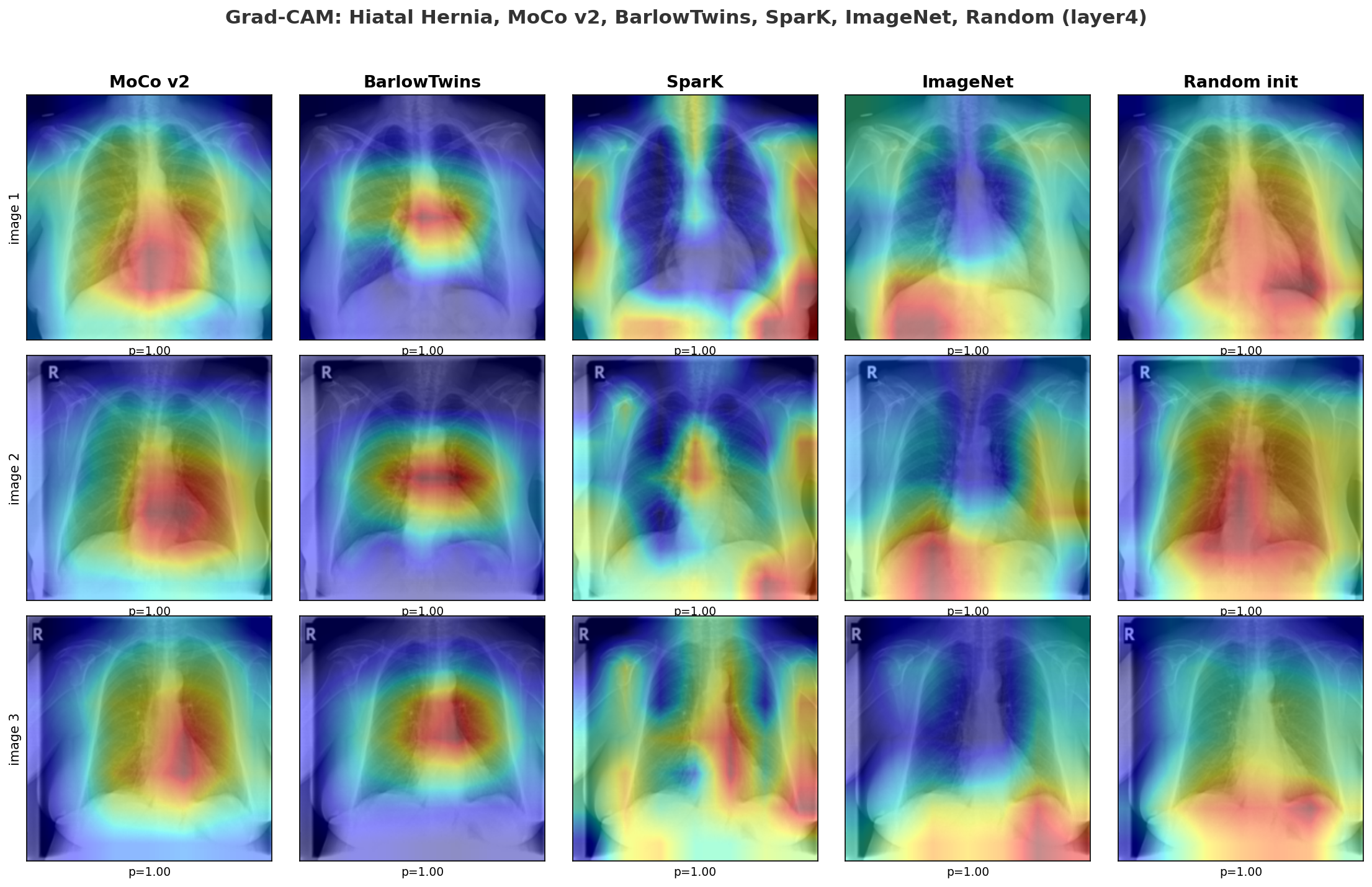 Grad-CAM at layer4 for hiatal hernia across all five initializations: MoCo v2, BarlowTwins, SparK, ImageNet, Random