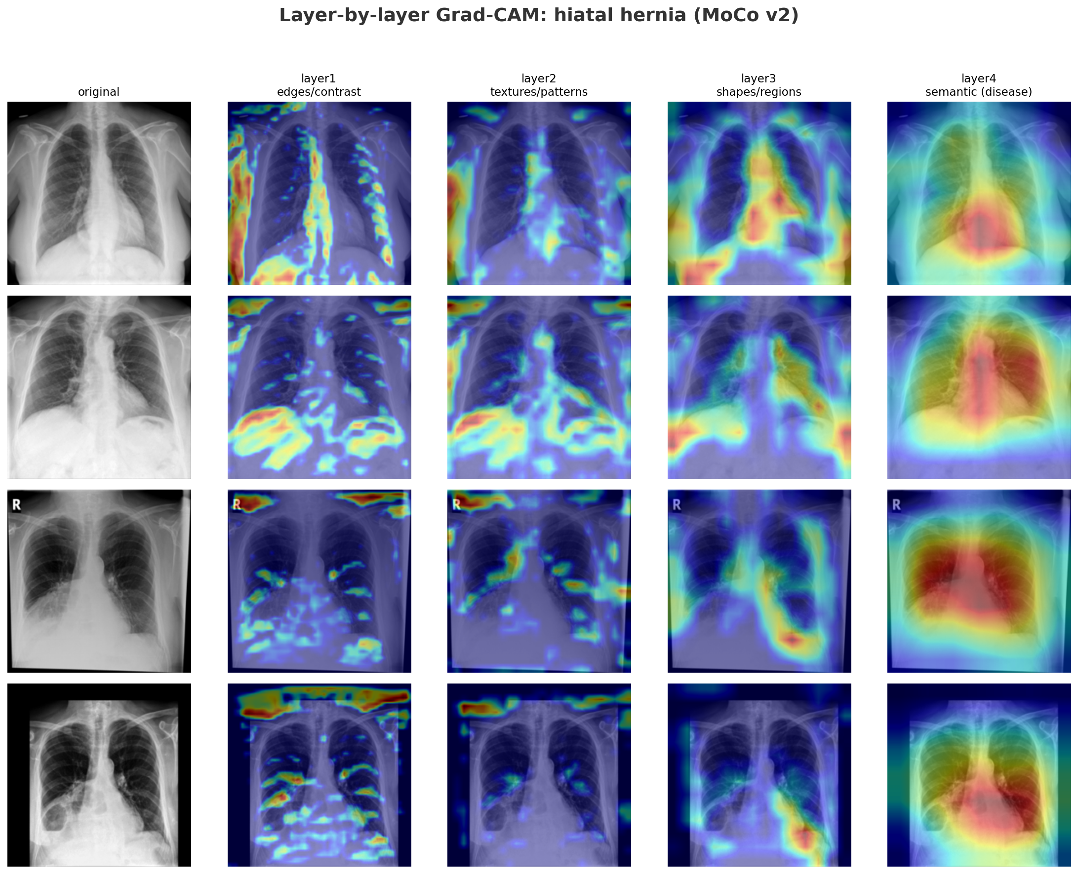 Layer-wise GradCAM: layer1 through layer4 on hiatal hernia