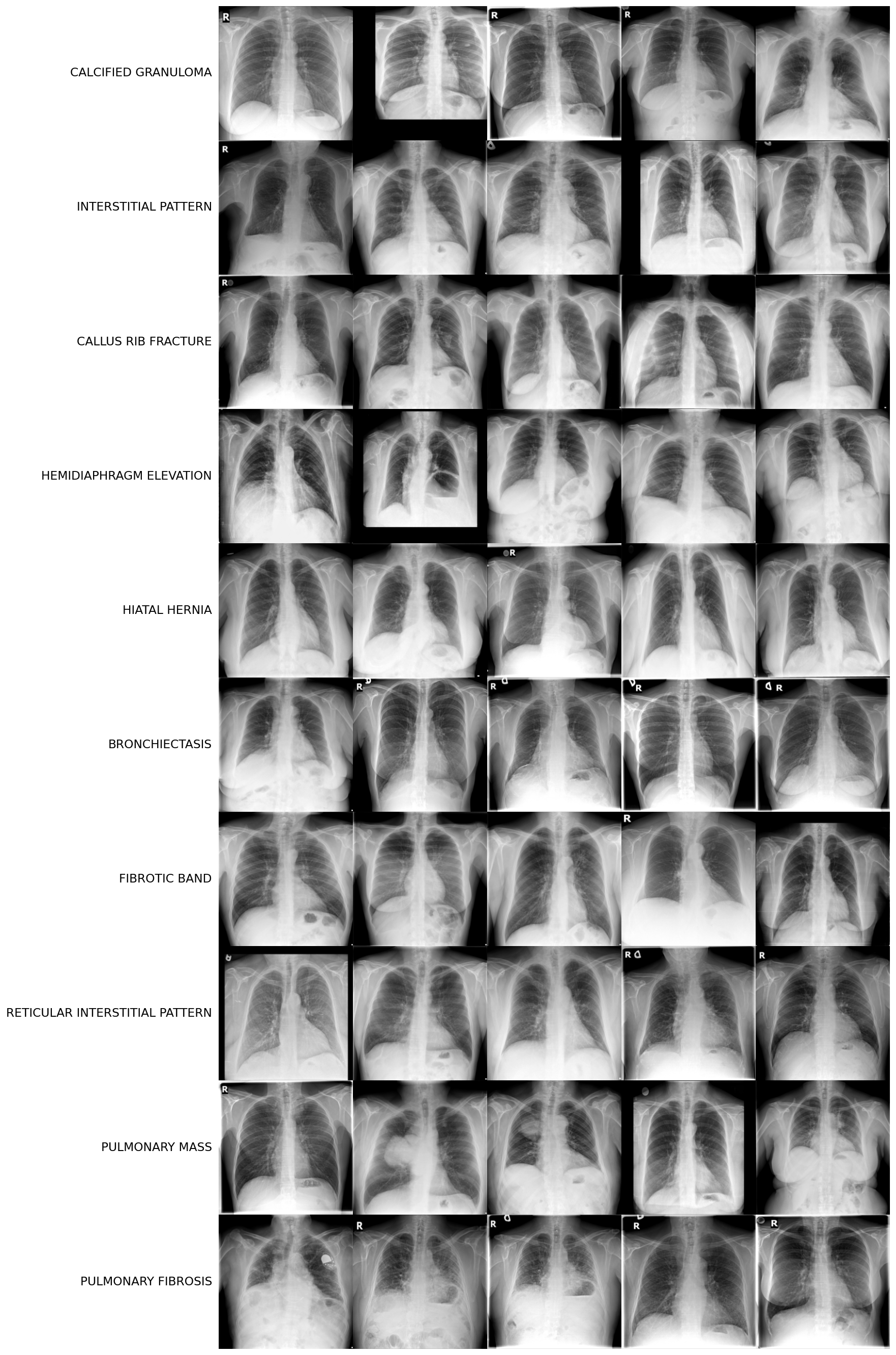 PadChest disease examples: 10 rare disease classes, 4 examples each