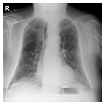 Excluded multi-label image annotated with pulmonary fibrosis plus four other findings