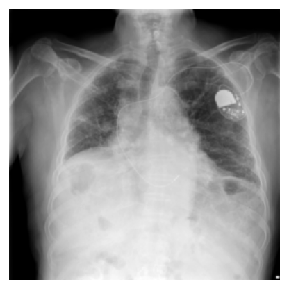 Included single-label image annotated with pulmonary fibrosis only