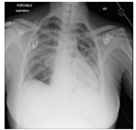 512×512 chest X-ray